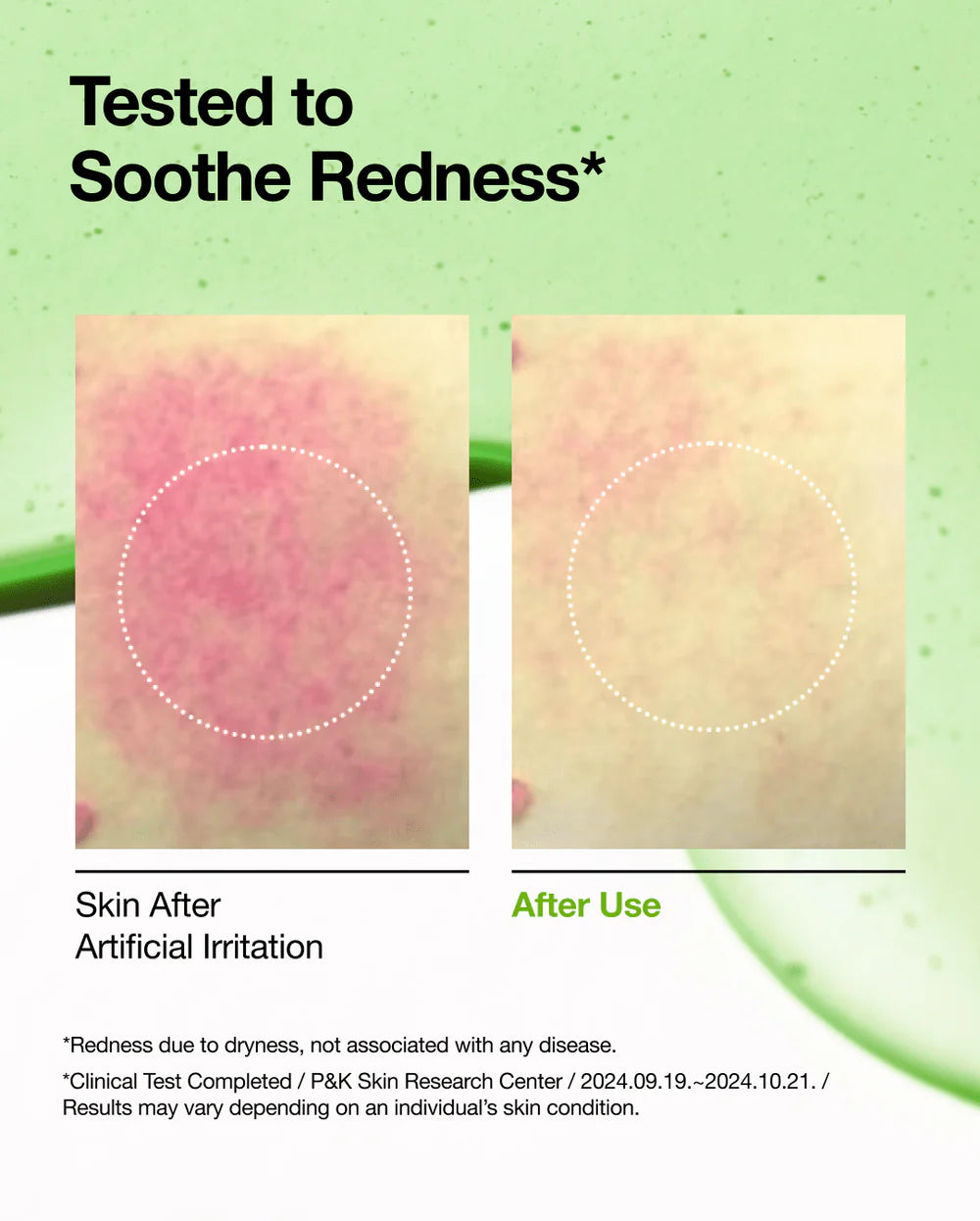 Anua - Azelaic Acid 10 Hyaluron Redness Soothing Serum 30ml